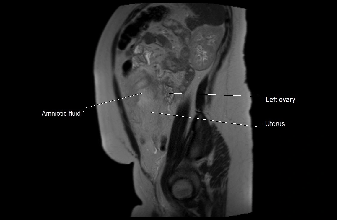 MRI fetal anatomy sagittal image 28.webp